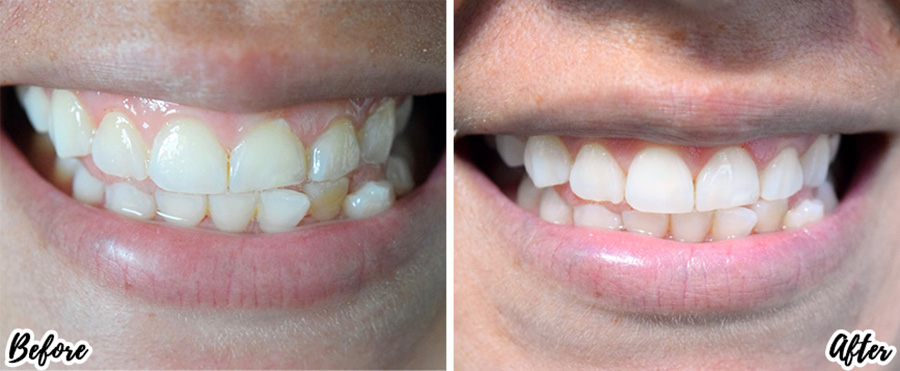 Smile brilliant, whitening, teeth whitening, teeths, dentist, at home whitening, beauty, lifestyle, before and after, dental, brighter white, smile, teeth whitening kit, review, beauty review, makeup, bblogger